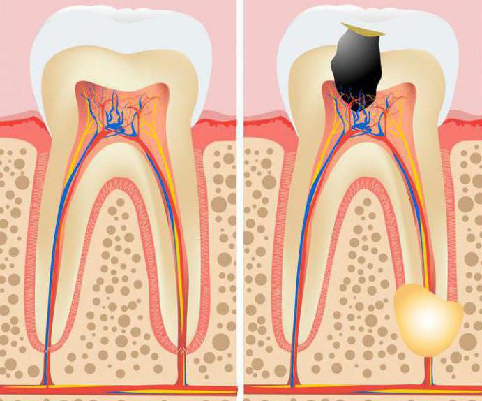 Удаление гранулемы зуба