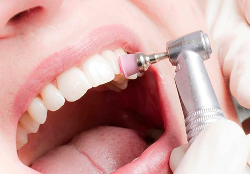 Покрытие зубов фторсодержащими препаратами